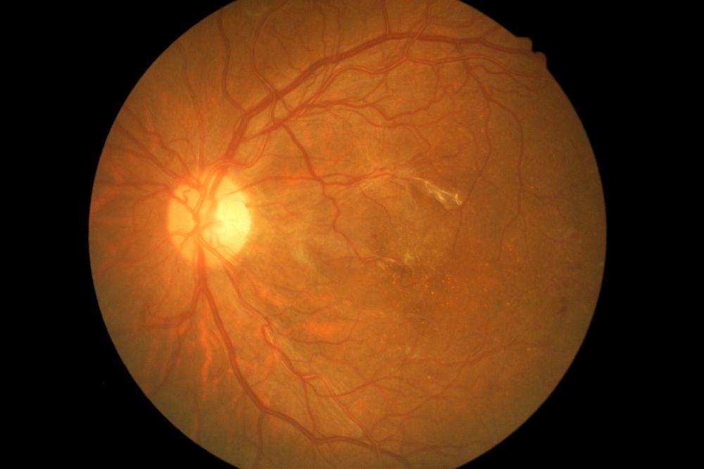 trec-neovascularization